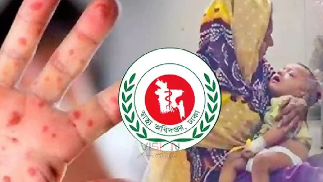 এবার ২৪ ঘন্টায় হাম ও উপসর্গ নিয়ে মৃত্যুর রেকর্ড
