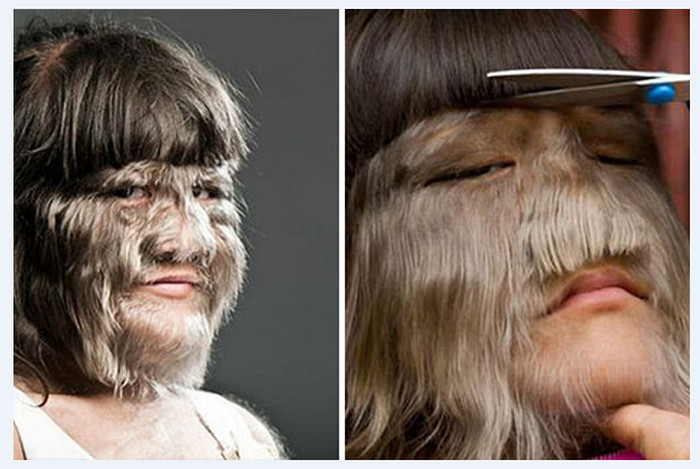 বিয়ের পিঁড়িতে সেই ‘লোমশ কন্যা’!