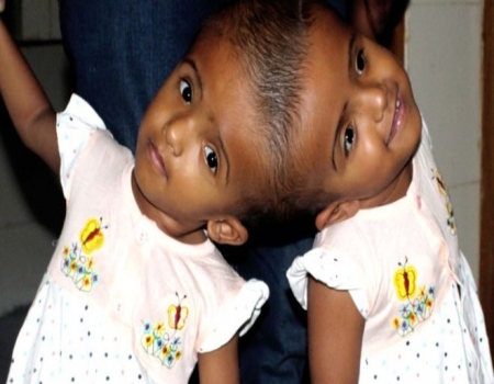 জোড়া মাথার দুটো শিশুকে আলাদা করছেন ডাক্তাররা