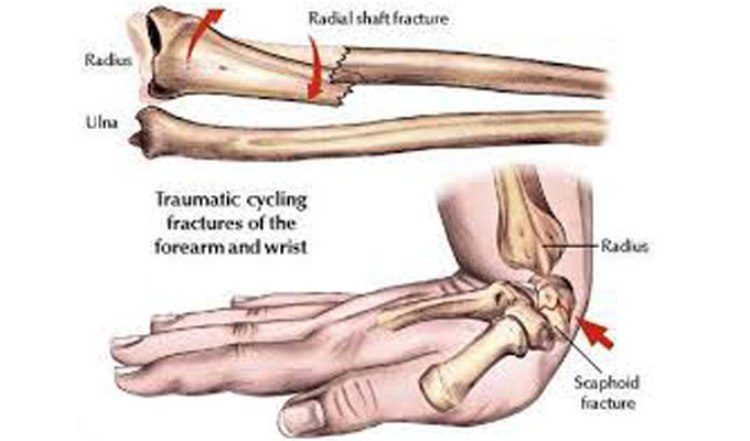 শরীরে ক্যালসিয়ামের ঘাটতি হলে…