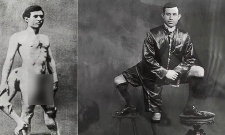 অবহেলাকে ছাপিয়ে খ্যাতির শীর্ষে তিন পা ও দুই যৌনাঙ্গ বিশিষ্ট ব্যাক্তি