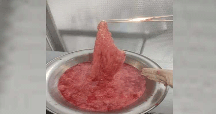 সিজারের পরে ব্যান্ডেজ রেখে সেলাই, ৭ মাস পর অপসারণ!