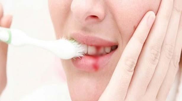 মাড়ি থেকে রক্ত পড়া বন্ধের ঘরোয়া উপায়