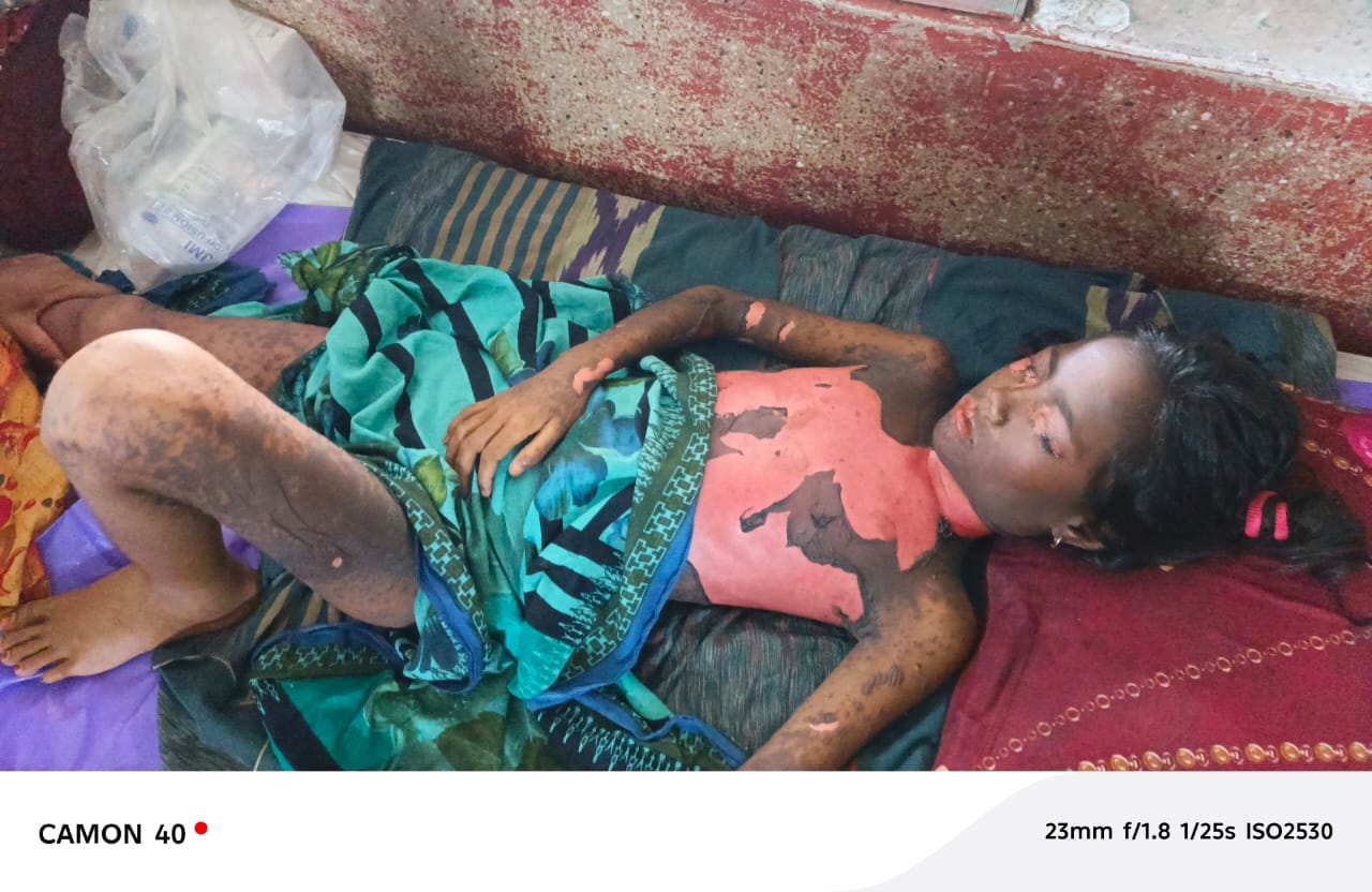 হাতুড়ে পল্লী চিকিৎসকের ভুল চিকিৎসায় সারা শরীরে ক্ষত নিয়ে হাসপাতালে কাতরাচ্ছে শিশু নুরজাহান